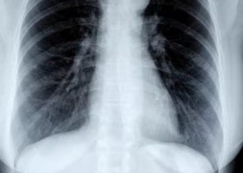 Escâner corporal detecta 56 porções de drogas no estômago de detentos em Valadares