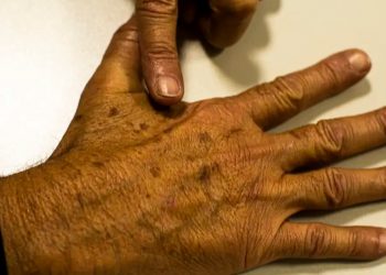 Dezembro Laranja: campanha faz alerta de cuidados para prevenção do câncer de pele