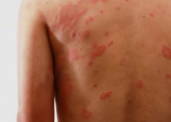 Pesquisa de professor da Univale contribui para o combate à hanseníase