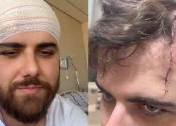 Zé Neto atualiza estado de saúde e mostra hematoma no olho