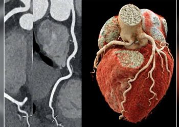 Angiotomografia de Coronária: Um Exame Menos Invasivo que Pode Revolucionar a Rotina Cardiovascular