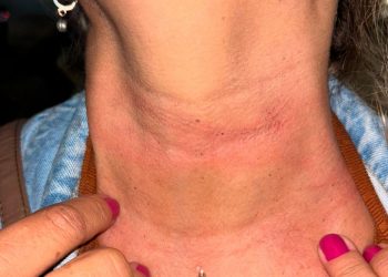 Mulher sofre acidente de moto ao enroscar em fio na JK, em Valadares