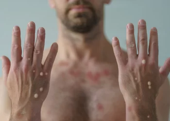 Brasil registra 88 casos de Mpox em 2026; saiba como evitar a doença